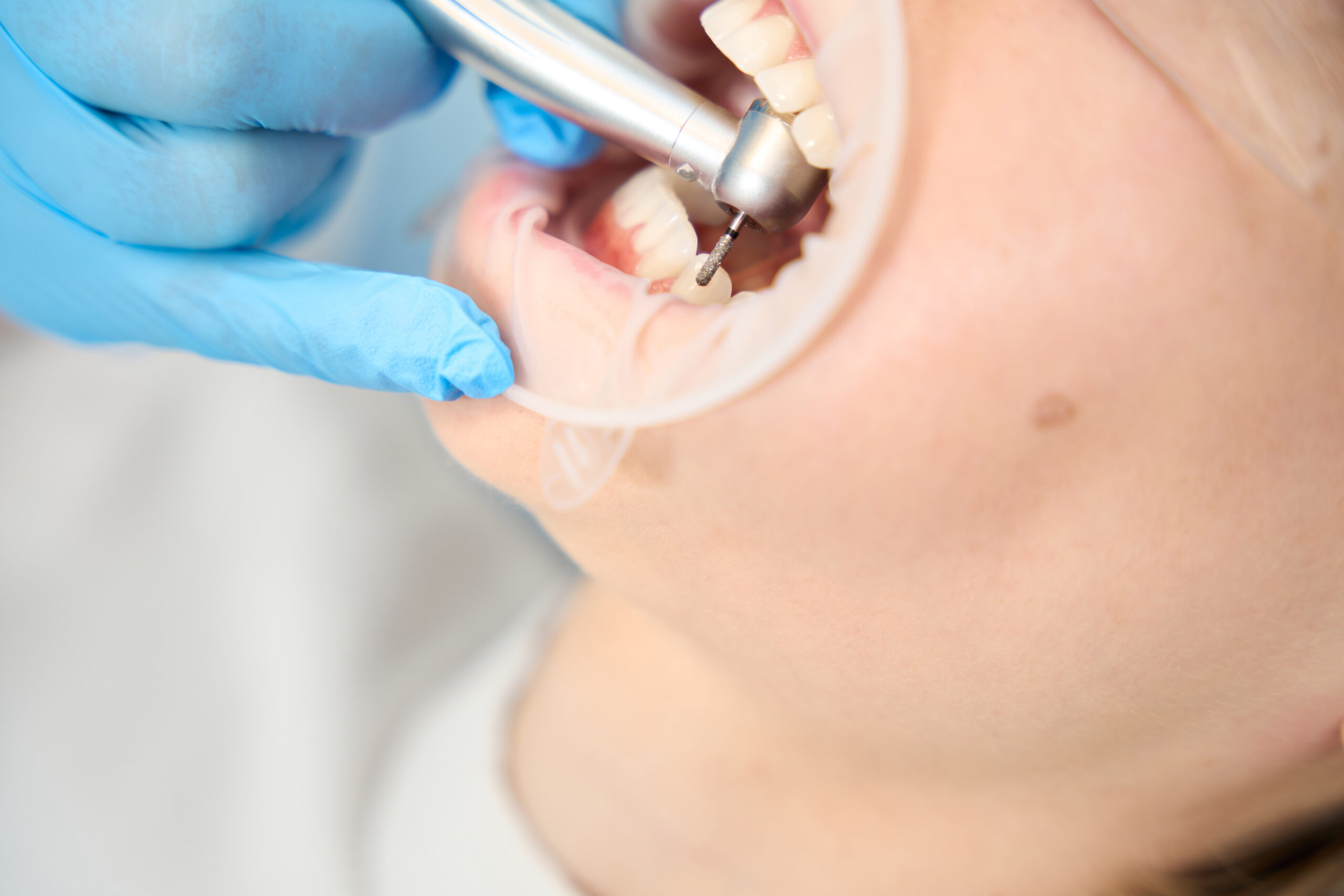 Composite Fillings