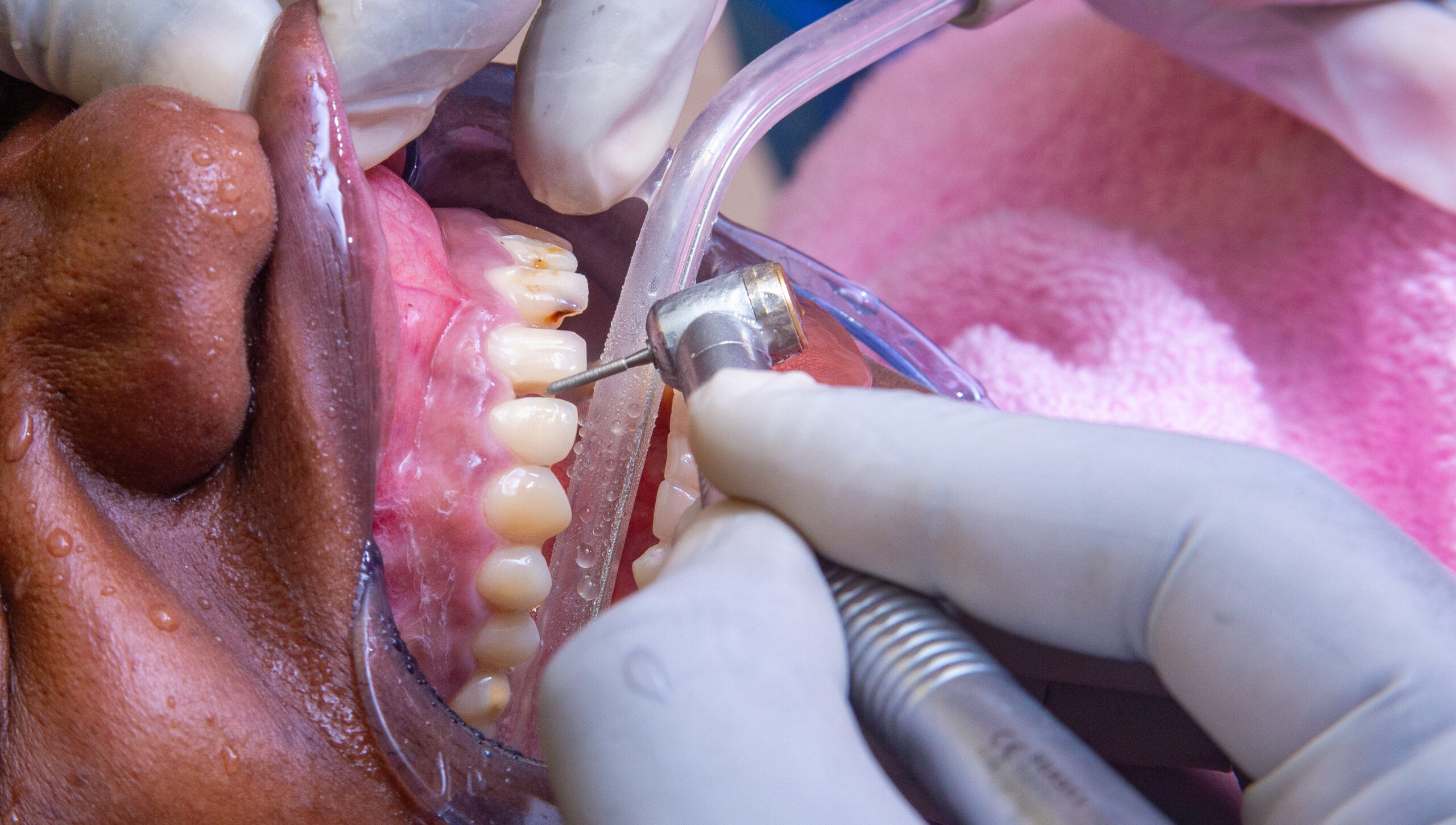 Periodontal Treatment