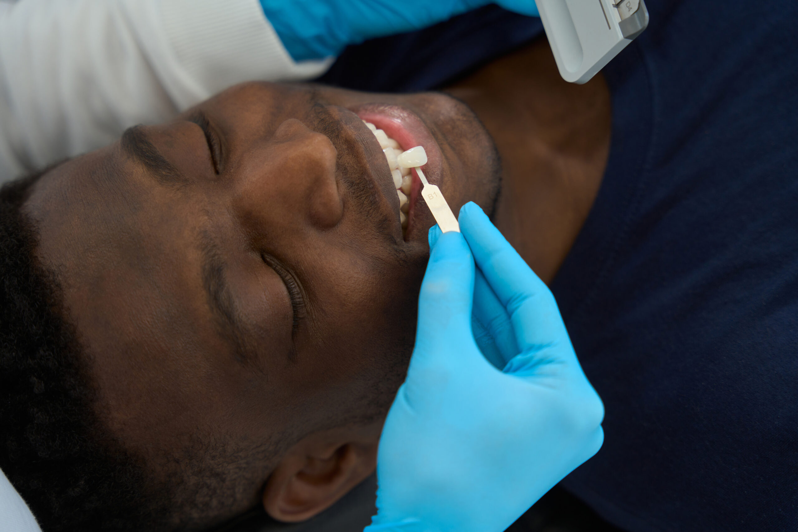 Veneers