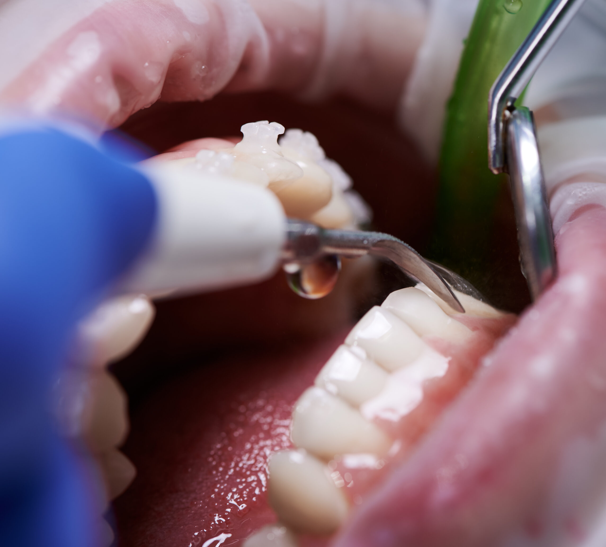 Prophylaxis (Advanced Teeth Cleaning)